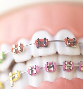 A mouth mold that has traditional braces affixed and colorful bands wrapped around each bracket