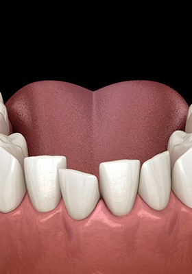 Illustration of crowded teeth