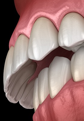 Illustration of overbite