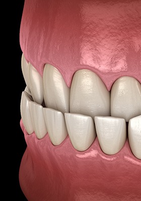 Illustration of underbite