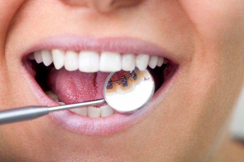 Woman with lingual braces