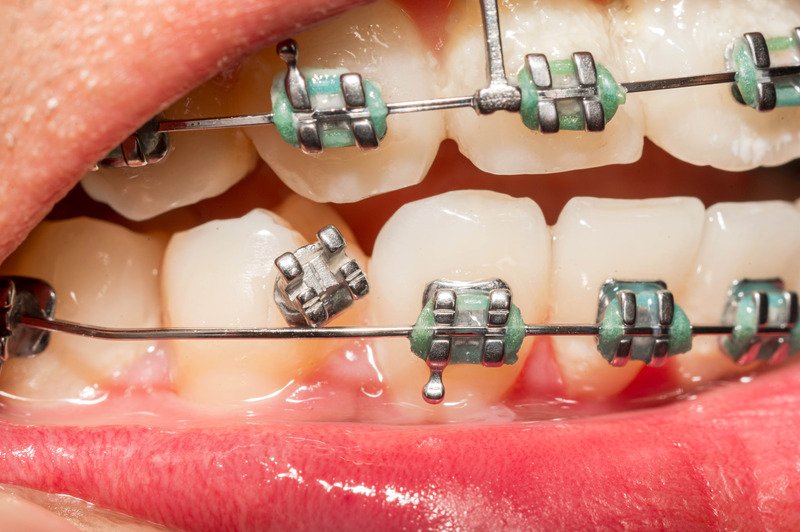 Patient with broken braces